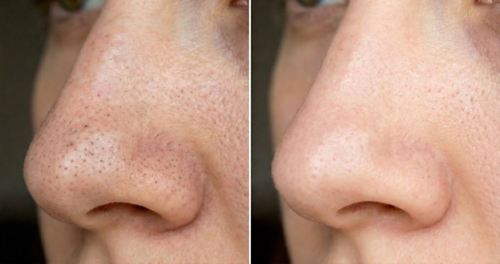 Cellufin™ Hydrocolloid Nose Patches