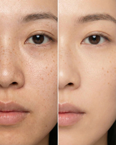 Cellufin™ Hydrocolloid Nose Patches